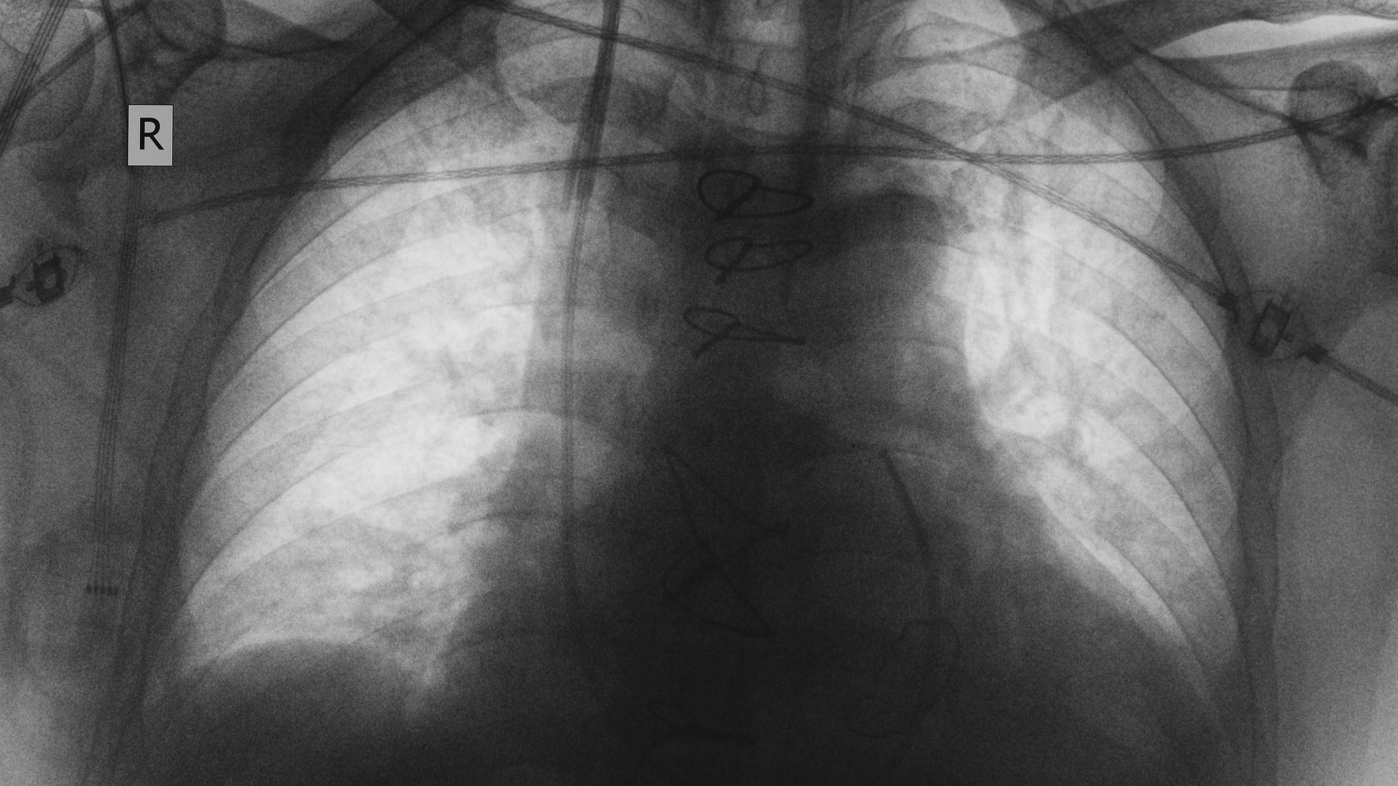lung Disease